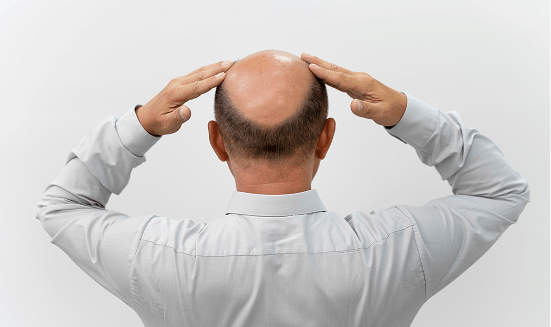 Alopecia Androgenética